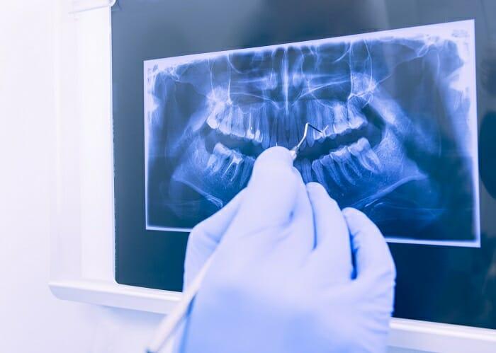 Radiografía de una dentadura en un dentista